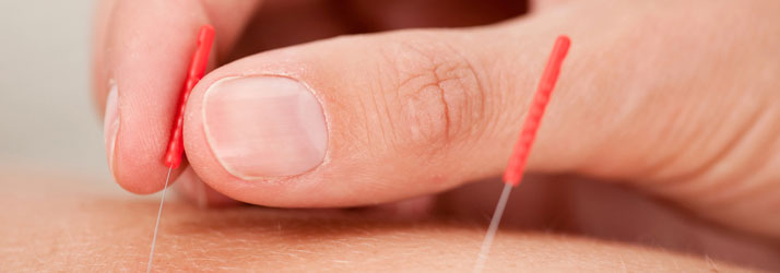 Chiropractic Plano TX Dry Needling